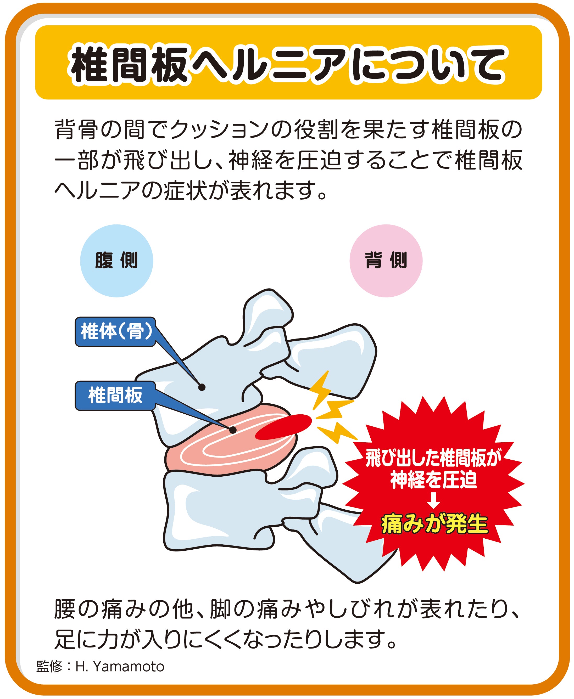 E-27 椎間板ヘルニアについて – JFPA®オンラインショップ