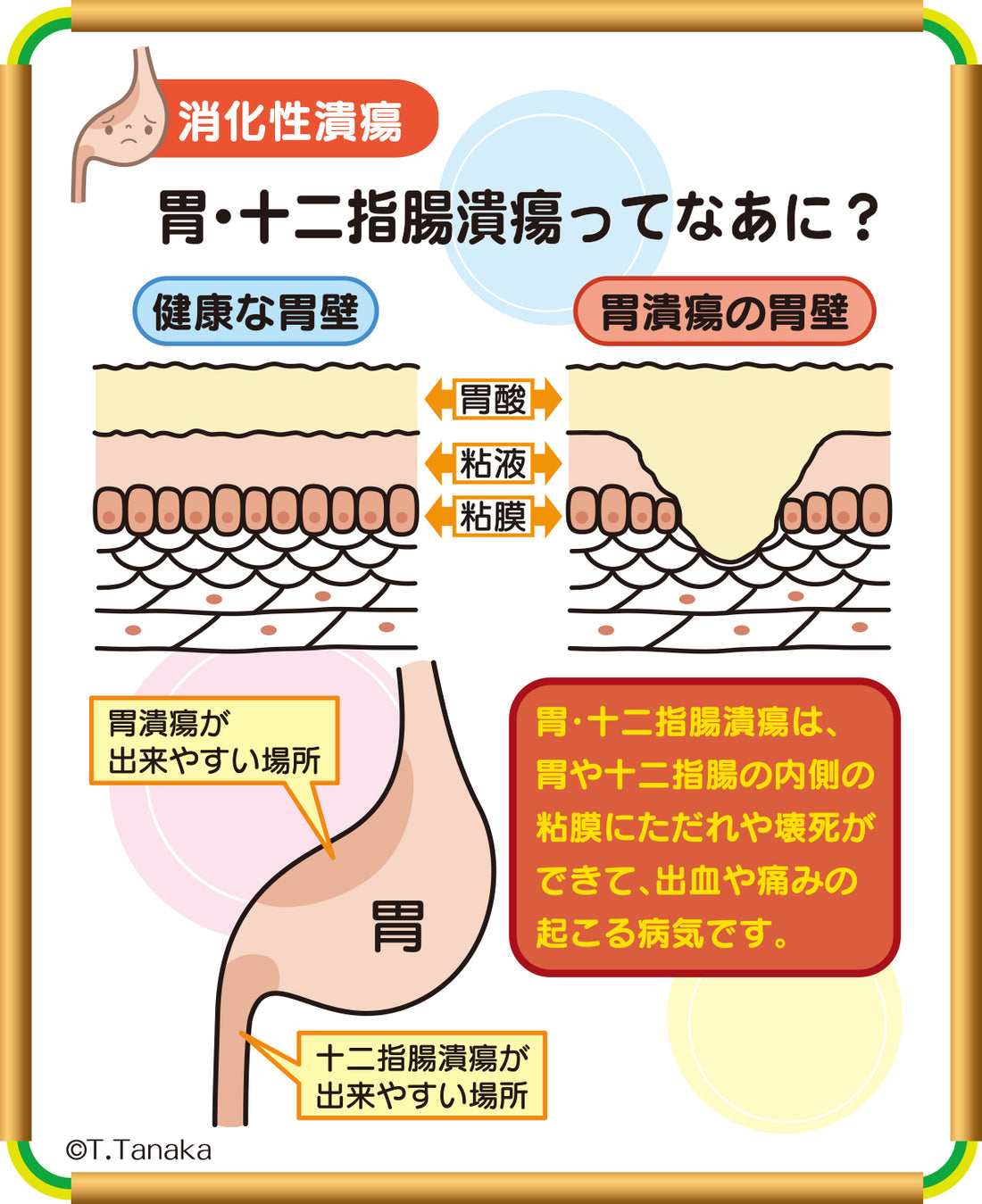 B-226 胃・十二指腸潰瘍ってなあに？ – JFPA®オンラインショップ