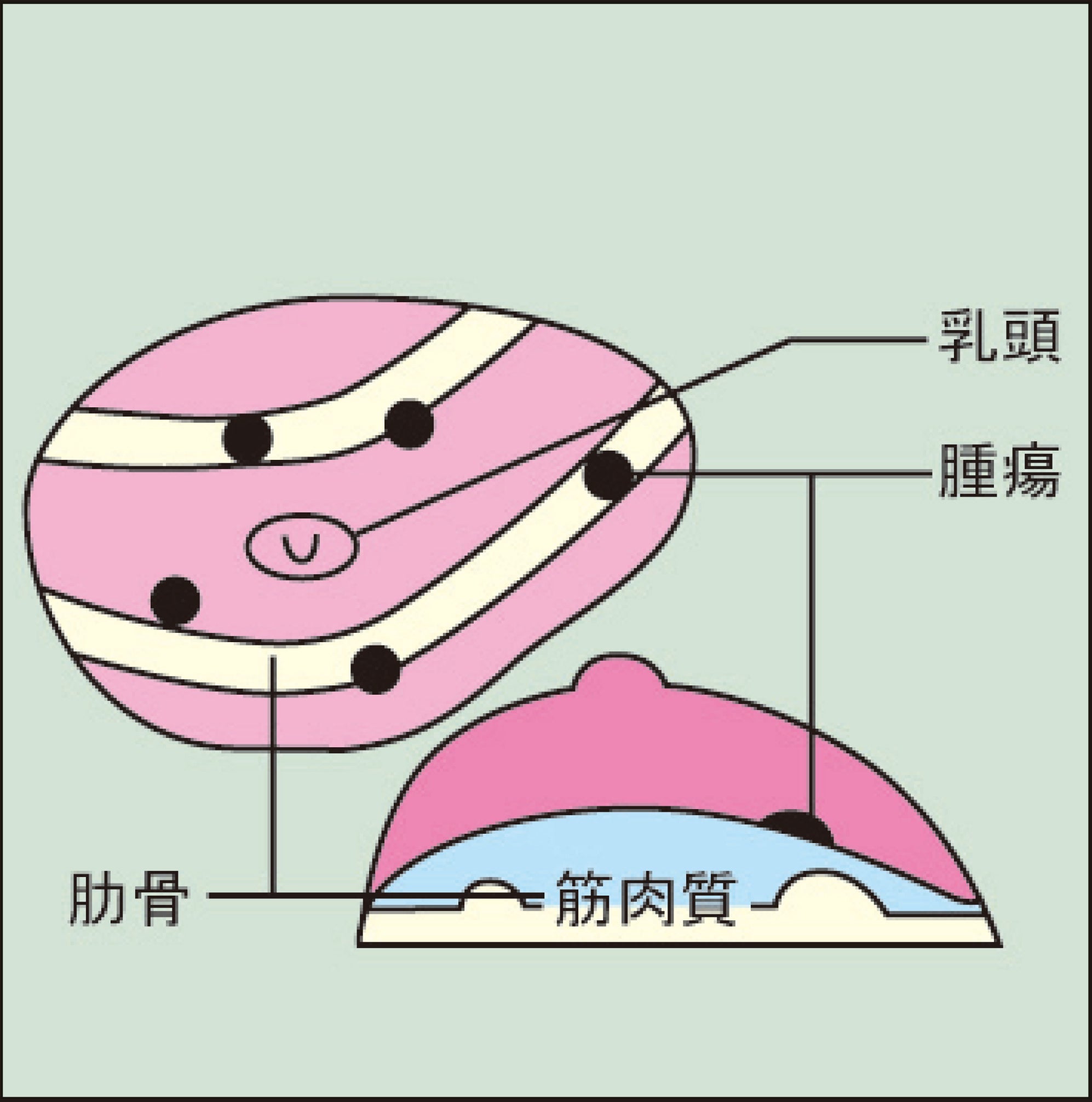 乳がん触診モデル1型